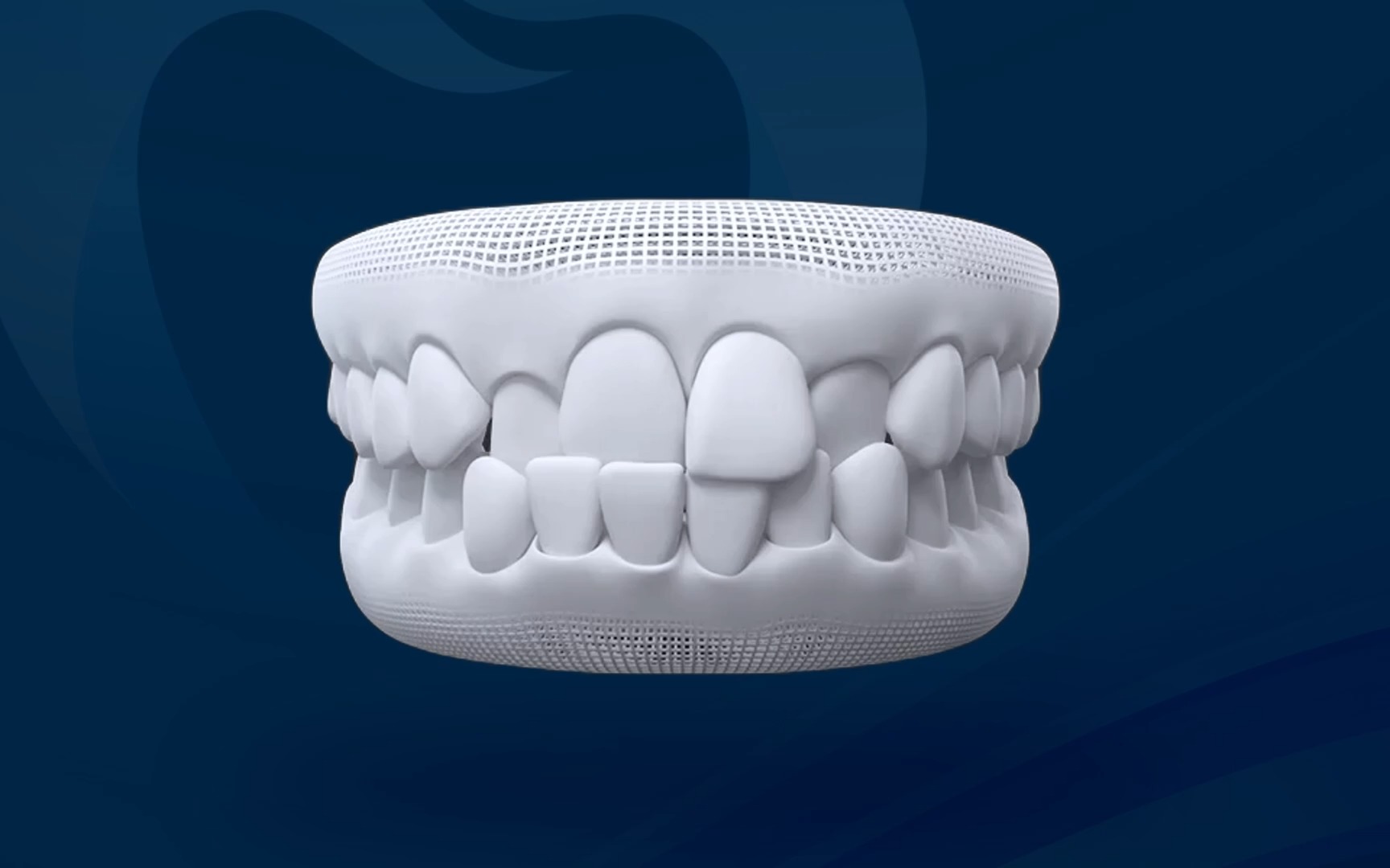Khớp cắn chéo - Một số răng hàm trên nằm trong răng hàm dưới khi cắn