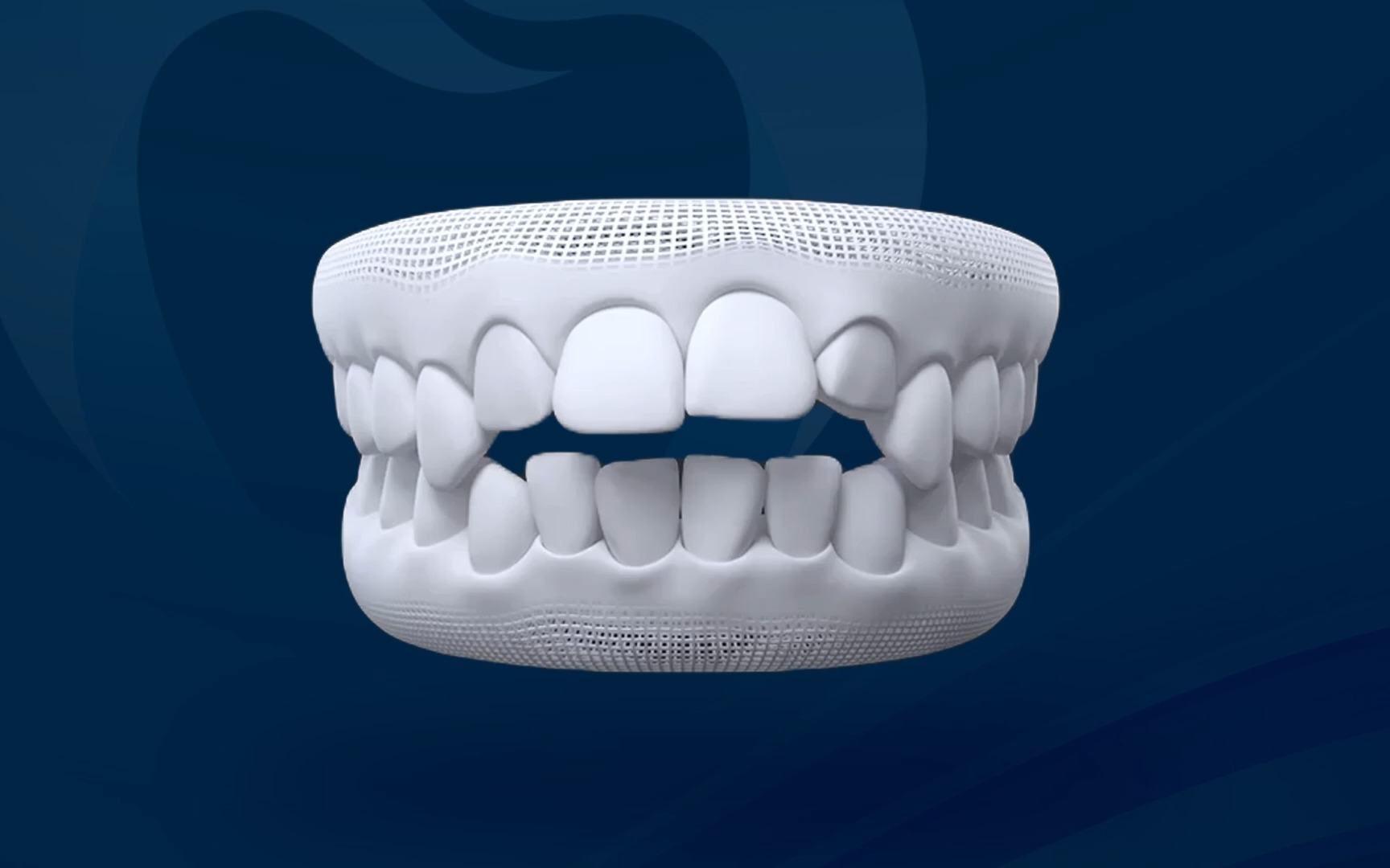 Khớp cắn hở - Răng hàm trên và dưới không chạm nhau khi ngậm miệng