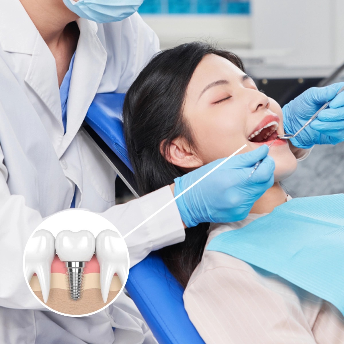 Cấy ghép implant