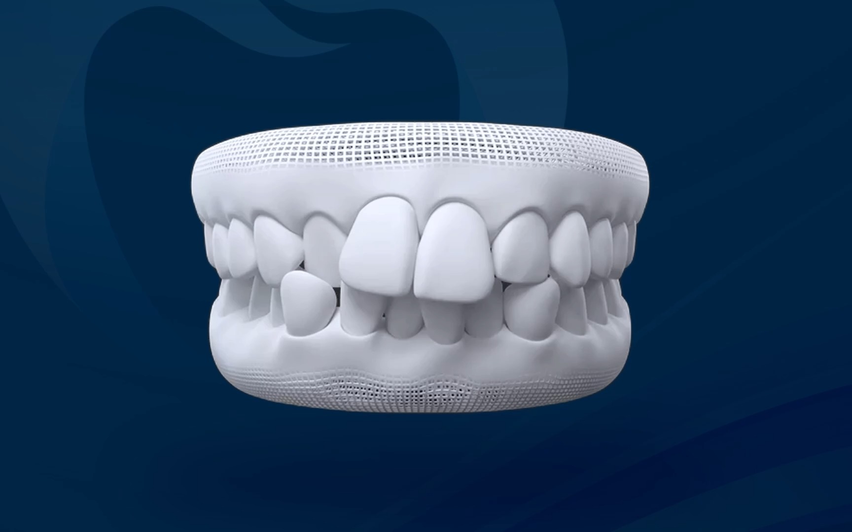 Răng chen chúc - Răng mọc lấn, xoay hoặc chồng lên nhau