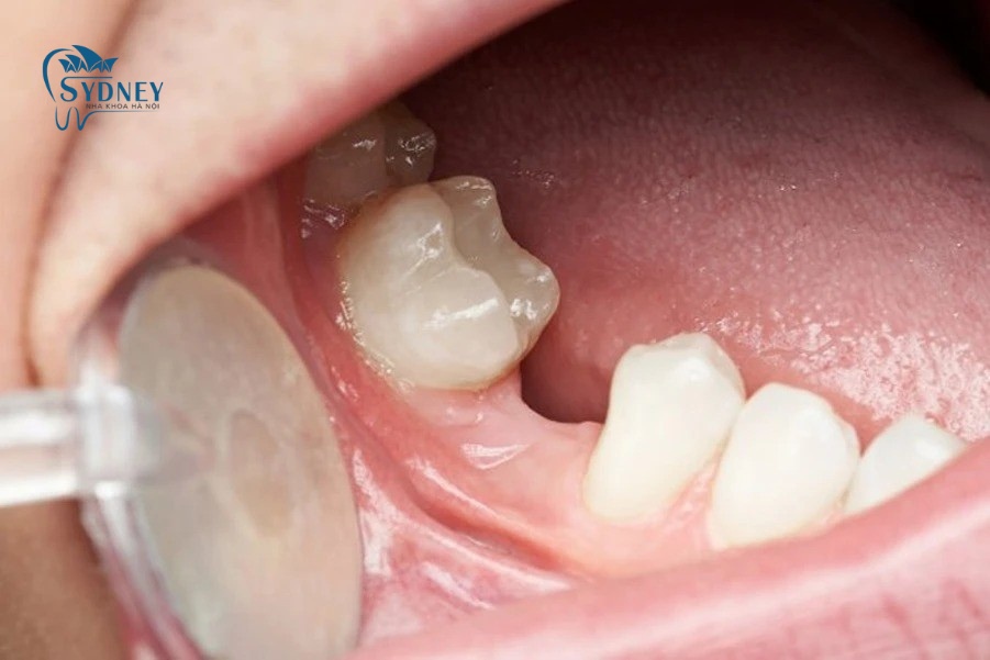 Người bị mất răng có nhu cầu phục hồi lại răng đã mất