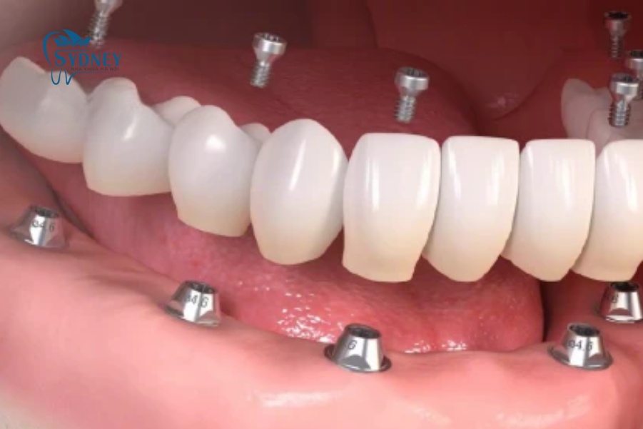 Bị mất răng nhưng không muốn sử dụng hàm tháo lắp