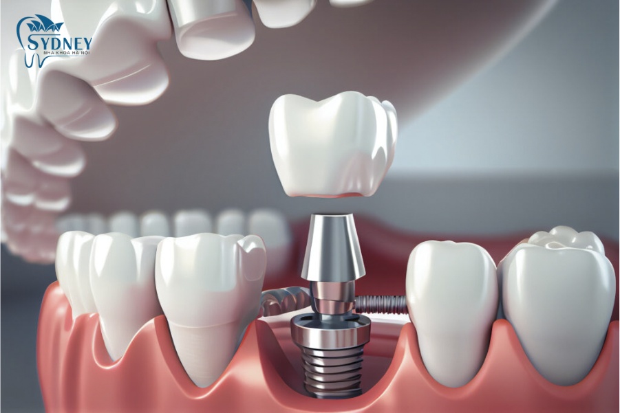 Người có nhu cầu làm răng giả mà không gây tổn thương hàm, đặc biệt là ở vùng thẩm mỹ