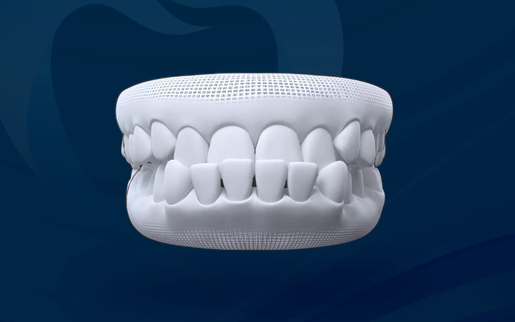 Khớp cắn ngược - Răng cửa hàm dưới chìa ra ngoài so với hàm trên
