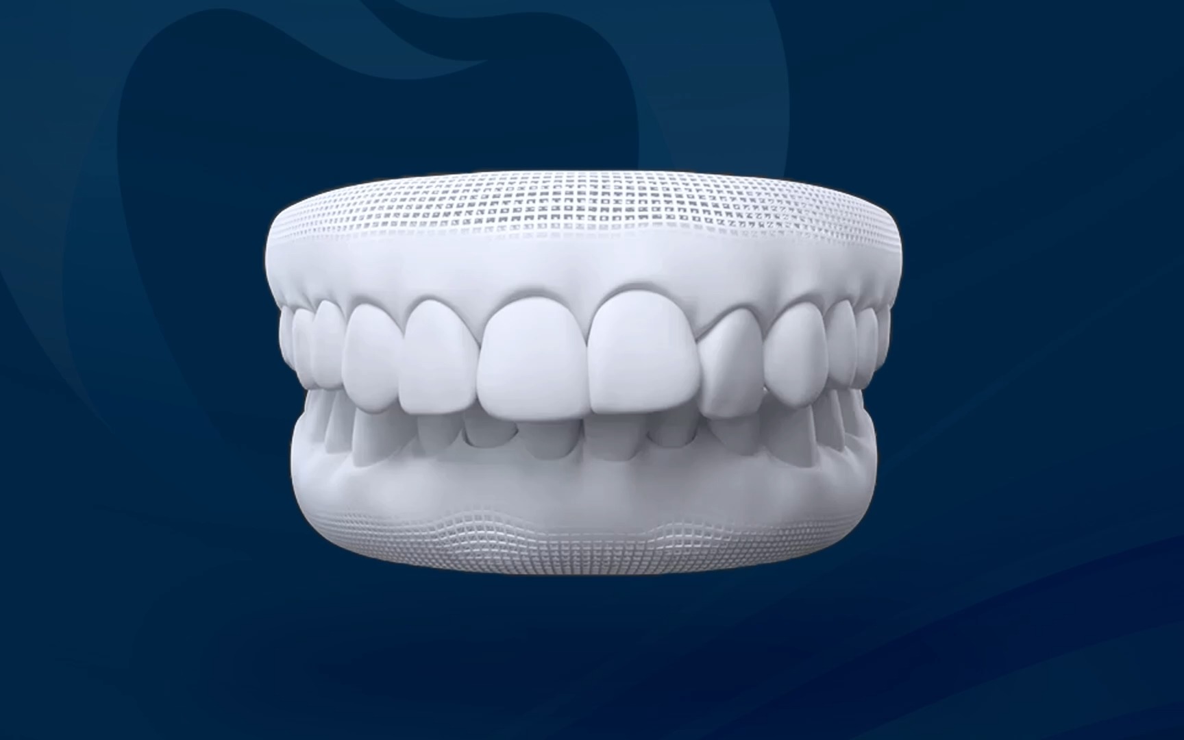 Khớp cắn sâu - Răng cửa hàm trên che phủ quá nhiều răng cửa hàm dưới