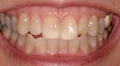 Antibiotic-stained teeth