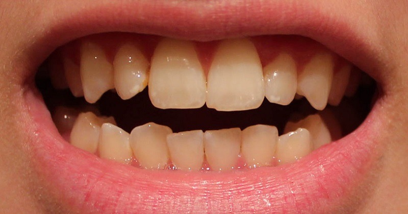 Severely discolored teeth
