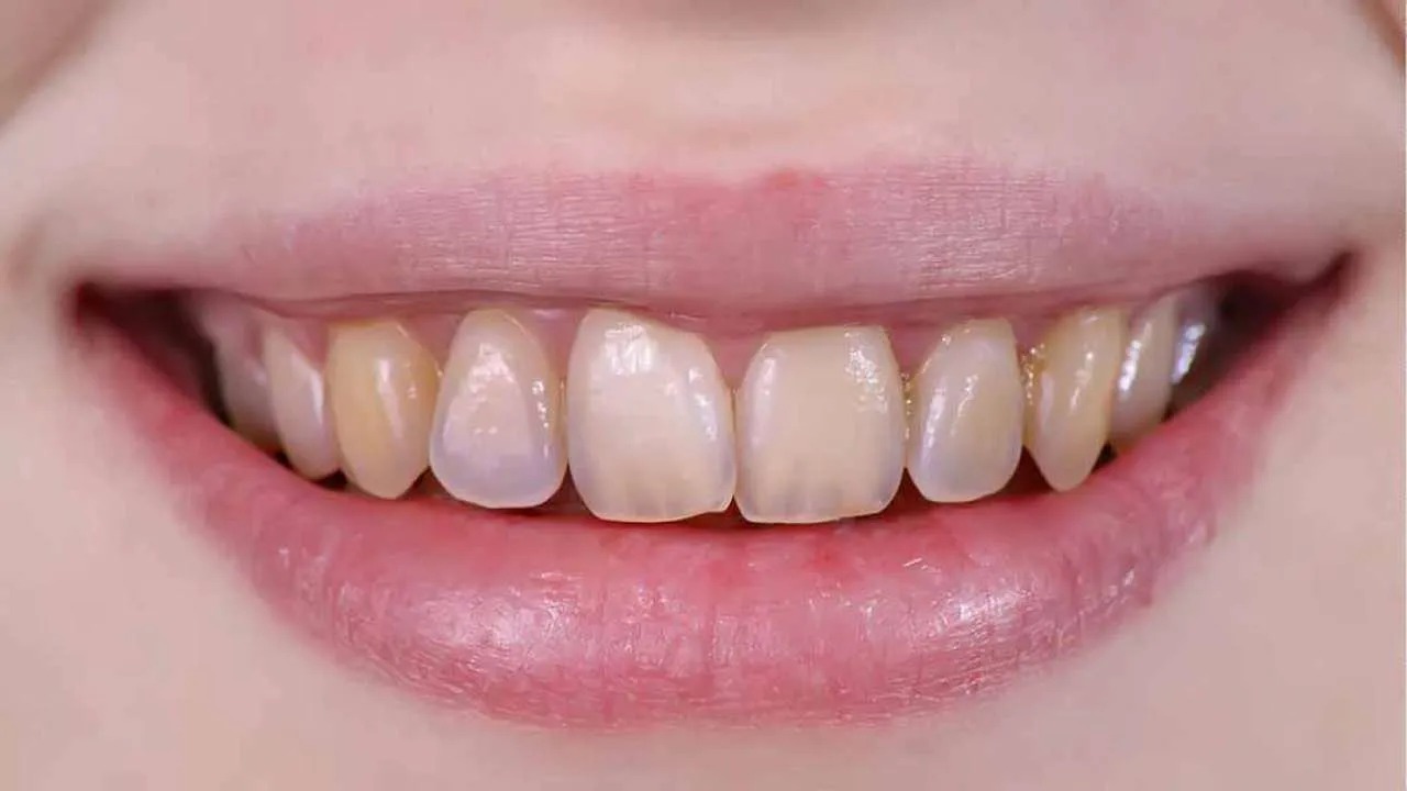 Yellow discolored teeth