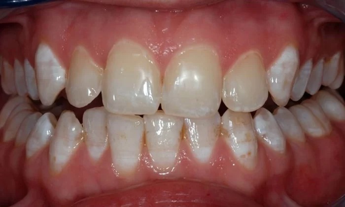 Fluorosis teeth