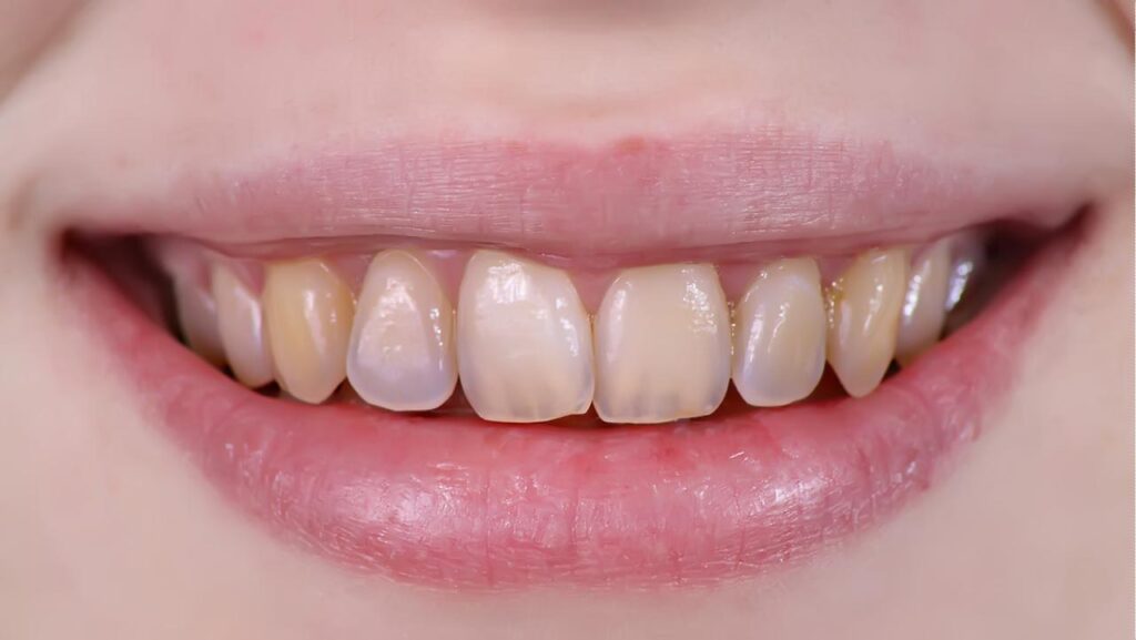 Răng bị xỉn màu